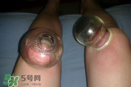 小腿能拔罐嗎？在小腿上拔火罐有什么作用？