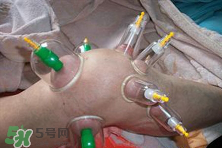 小腿能拔罐嗎？在小腿上拔火罐有什么作用？