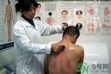 刮痧可以減肥嗎？刮痧減肥有效果嗎？