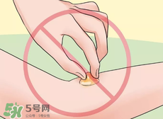 水泡怎么處理？水泡要不要刺破？