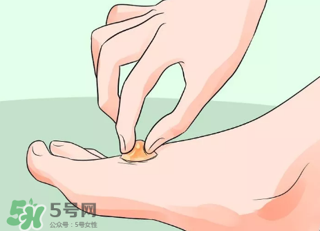 水泡怎么處理？水泡要不要刺破？