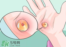 水泡怎么處理？水泡要不要刺破？