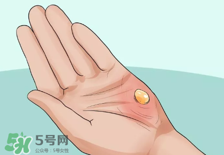 水泡怎么處理？水泡要不要刺破？