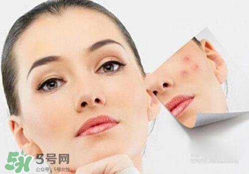 封閉性粉刺會自己消失嗎？封閉性粉刺好了會留疤嗎？