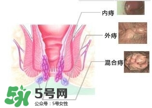 痔瘡吃什么藥效果好？痔瘡吃什么藥好得快？