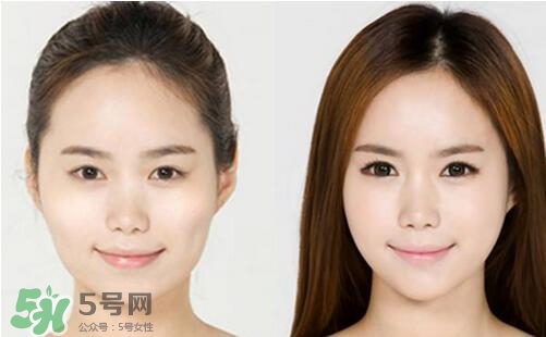 瘦臉針分為幾種類型？瘦臉針有哪幾個(gè)牌子？