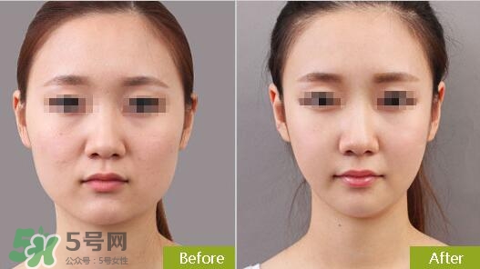 瘦臉針分為幾種類型？瘦臉針有哪幾個(gè)牌子？