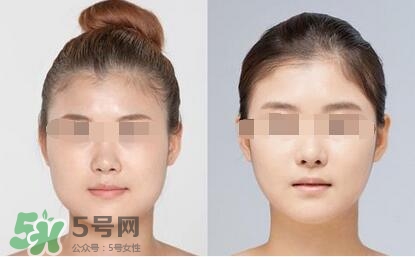 瘦臉針分為幾種類型？瘦臉針有哪幾個(gè)牌子？