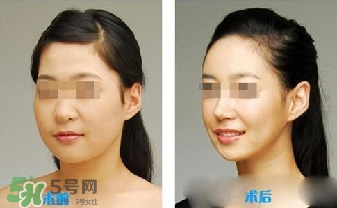 瘦臉針分為幾種類型？瘦臉針有哪幾個(gè)牌子？