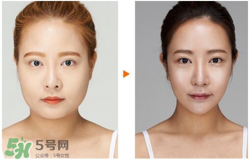 瘦臉針分為幾種類型？瘦臉針有哪幾個(gè)牌子？
