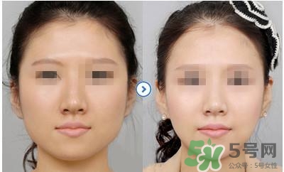 打瘦臉針疼不疼？打瘦臉針的注意事項(xiàng)