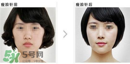 打瘦臉針能喝酒嗎？打瘦臉針能吃海鮮嗎？