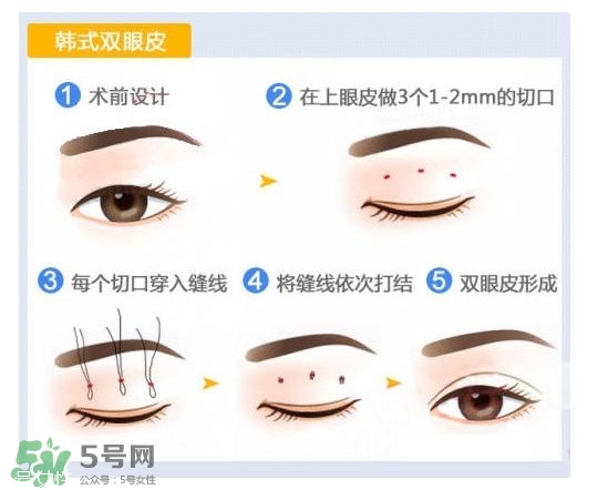 割雙眼皮有幾種做法？雙眼皮有哪幾種形狀？