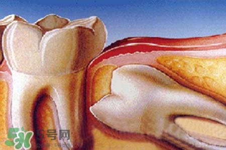 智齒經(jīng)常發(fā)炎怎么辦？智齒反復(fù)發(fā)炎腫痛怎么辦？