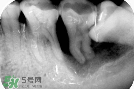 智齒會引起耳鳴嗎？耳鳴跟智齒有關(guān)系嗎？
