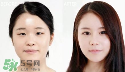 割雙眼皮有什么后遺癥嗎？割雙眼皮有什么危害性？