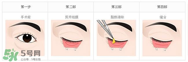 眼袋是怎么形成的？手術(shù)去眼袋安全嗎