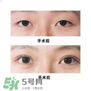 割雙眼皮疼不疼？割雙眼皮疼幾天能好？