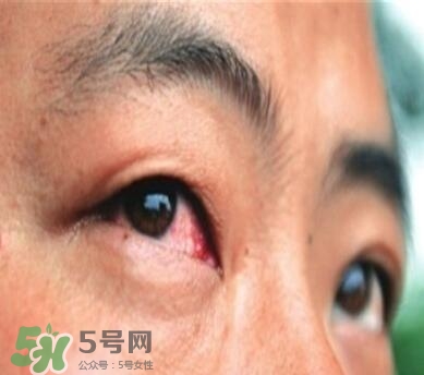 紅眼病是怎么引起的？紅眼病怎么產(chǎn)生的
