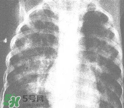 紅眼病是怎么引起的？紅眼病怎么產(chǎn)生的