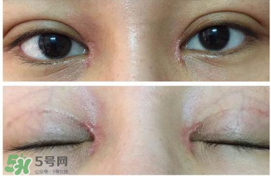 眼角增生是什么意思？眼角增生了怎么辦？