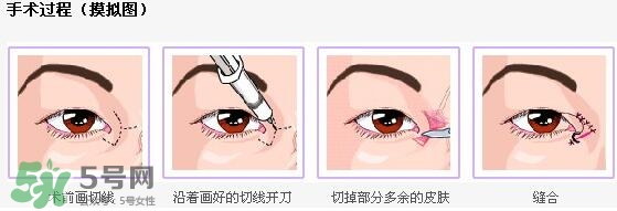 哪些人需要開眼角？需要開眼角的眼睛圖片