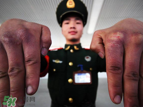 三月份還長(zhǎng)凍瘡嗎？三月份凍瘡沒(méi)好怎么辦？