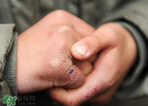三月份還長(zhǎng)凍瘡嗎？三月份凍瘡沒(méi)好怎么辦？