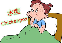 水痘是天花嗎？水痘是不是天花？