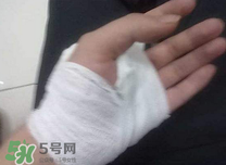 傷口化膿怎么處理？傷口化膿用什么藥好？