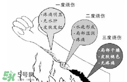 燙傷起泡要挑破嗎？燙傷起泡怎么處理？