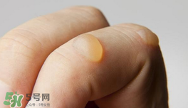 燙傷起泡要挑破嗎？燙傷起泡怎么處理？