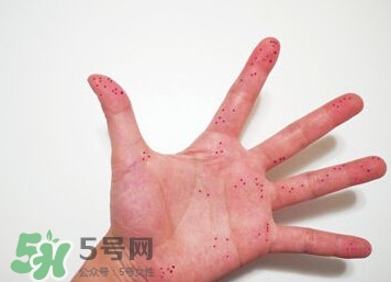 切辣椒后手很辣怎么辦？切辣椒后手很辣多久能好