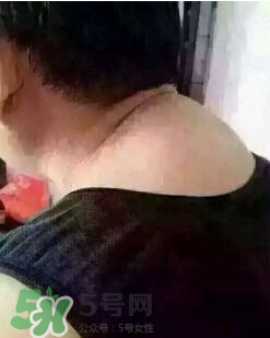 刮痧之后可以艾灸嗎？刮痧之后可不可以艾灸