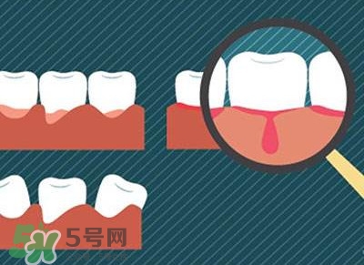 牙齦出血是什么原因？牙齦出血怎么回事
