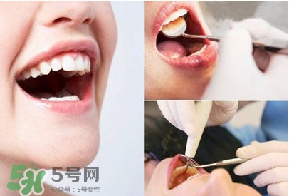 如何去掉牙結(jié)石？牙結(jié)石怎么去除