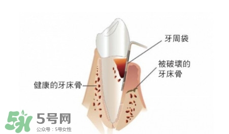 牙周炎怎么治療？牙周炎怎么治好