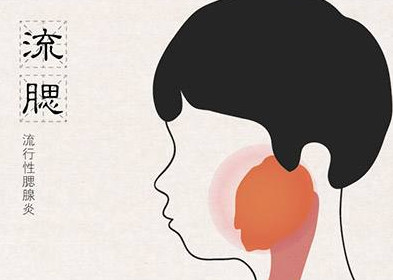 流行性腮腺炎有哪些癥狀？流行性腮腺炎的癥狀