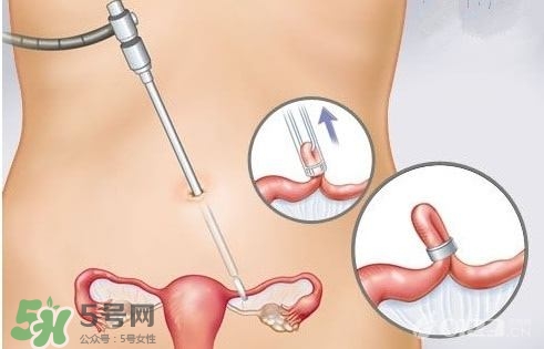 女人怎樣避孕最安全？對女人最好的避孕方法