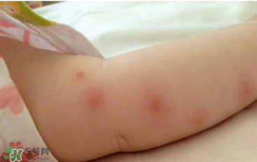 嬰兒蚊子咬了怎么消腫？嬰兒蚊子咬了怎么消腫止癢最快？