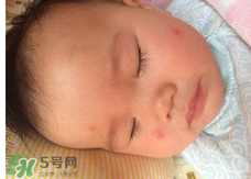 嬰兒蚊子咬了怎么消腫？嬰兒蚊子咬了怎么消腫止癢最快？