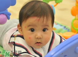 嬰兒被蚊子咬了如何去紅點(diǎn)？被蚊子咬后紅點(diǎn)如何去除？