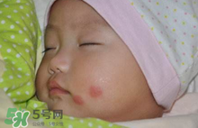 嬰兒被蚊子咬了如何去紅點(diǎn)？被蚊子咬后紅點(diǎn)如何去除？