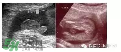 B超單數(shù)據(jù)怎么看男女？B超單看男女準(zhǔn)嗎？