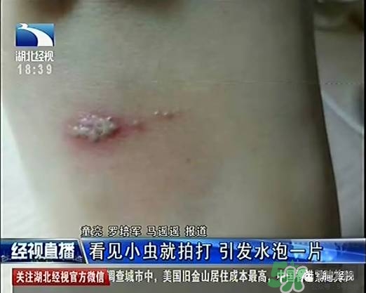 隱翅蟲(chóng)有毒嗎？隱翅蟲(chóng)會(huì)毀容嗎？