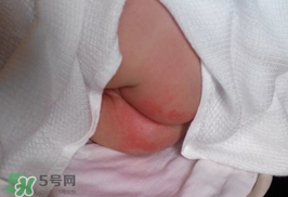 尿布疹怎么辦？寶寶尿布疹擦什么藥好？