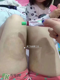 日本msd祛疤膏怎么樣？日本msd祛疤膏有用嗎？
