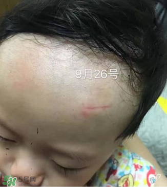 日本msd祛疤膏是抗生素嗎？日本msd祛疤膏是不是抗生素？
