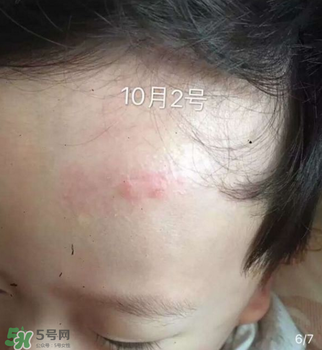日本msd祛疤膏是抗生素嗎？日本msd祛疤膏是不是抗生素？