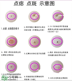 藥水點(diǎn)痣和激光點(diǎn)痣哪個(gè)好？各有什么優(yōu)缺點(diǎn)